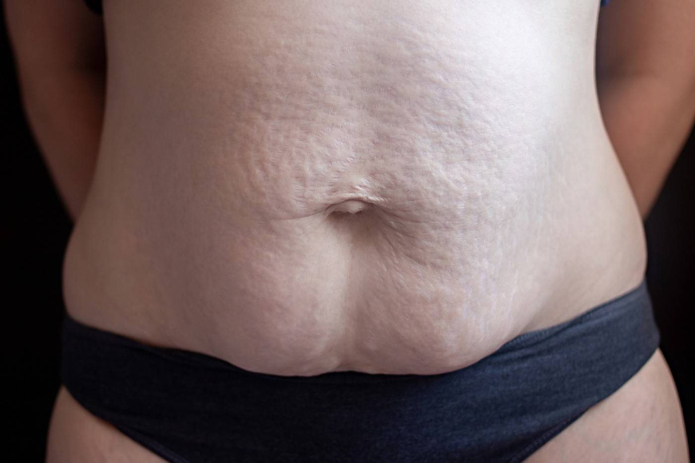 Maskateer - DIastasis Recti and what causes it and how to cure it Does  your tummy still looks pregnant months after delivery?? Do you feel bloated  easily? A postpartum abdominal condition called