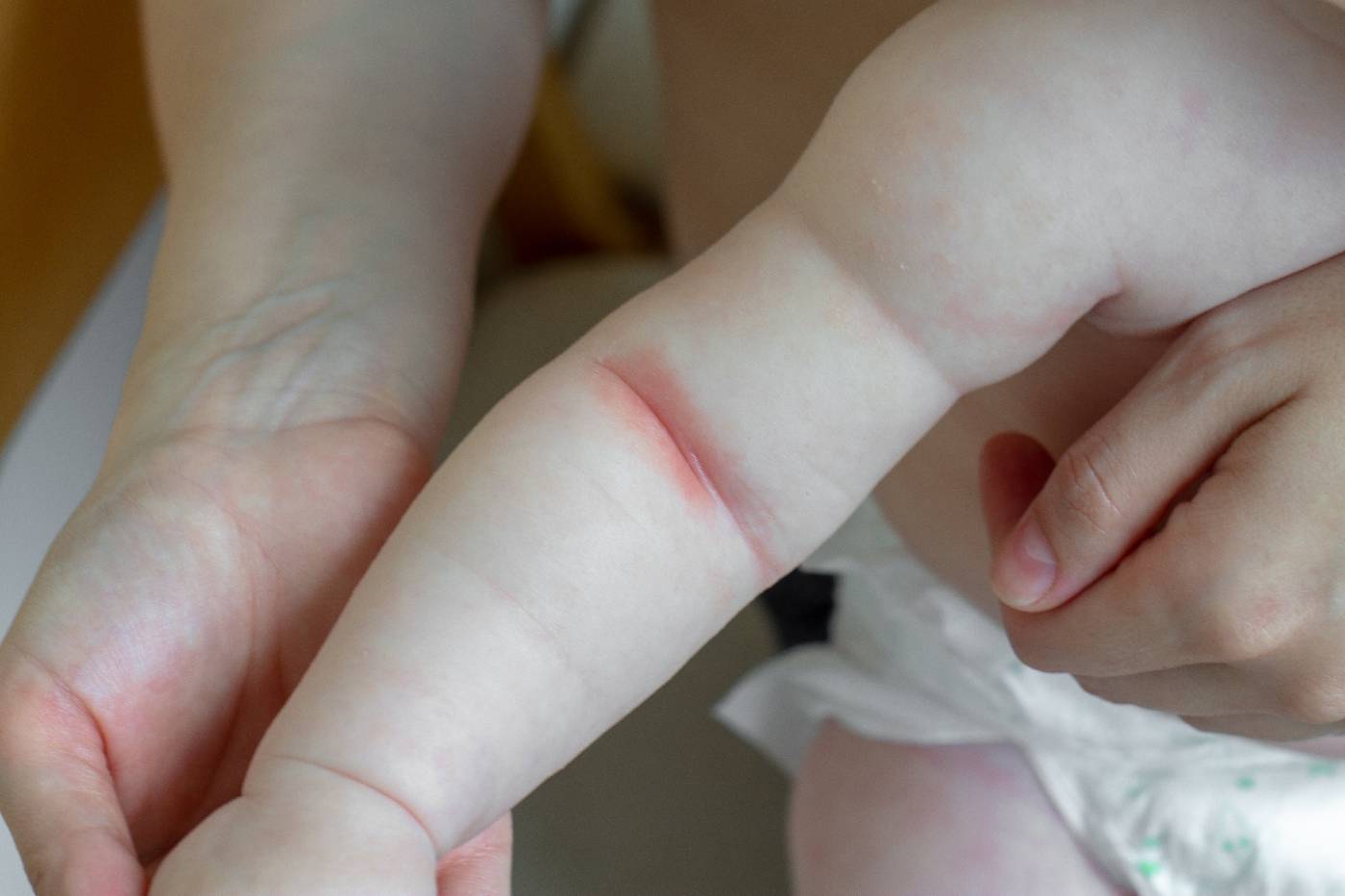 3 tips to try for safely alleviating red marks on baby's neck. Never p